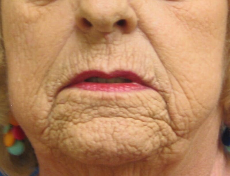 Laser Skin Resurfacing Before & After Gallery - Patient 261091 - Image 1