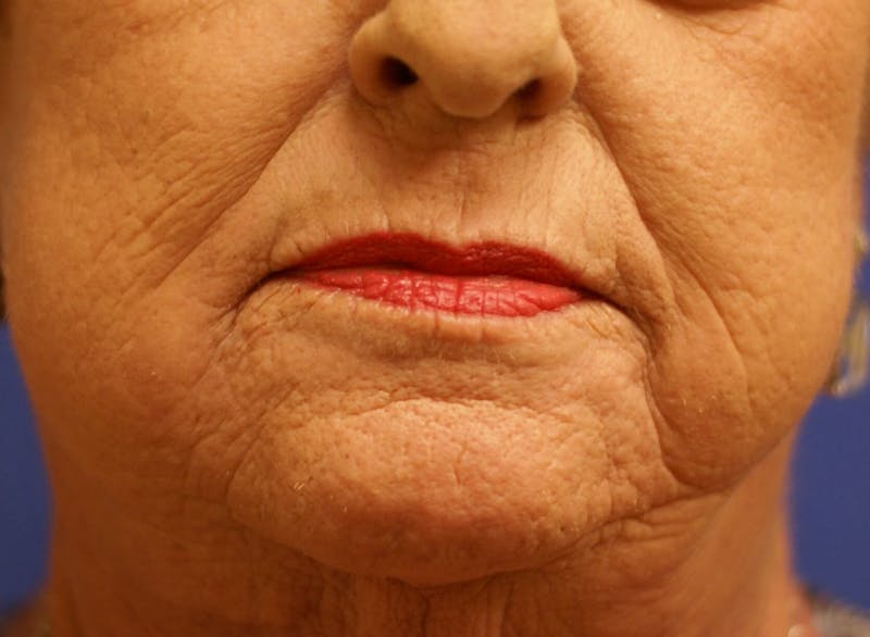 Laser Skin Resurfacing Before & After Gallery - Patient 261091 - Image 2
