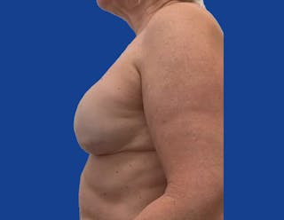 Breast Reconstruction Before & After Gallery - Patient 378044 - Image 6