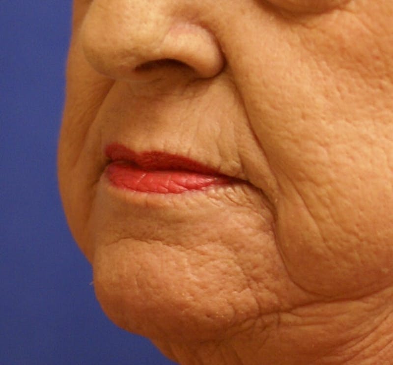 Laser Skin Resurfacing Before & After Gallery - Patient 261091 - Image 4