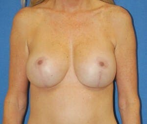 Breast Revision Before & After Gallery - Patient 428661 - Image 2