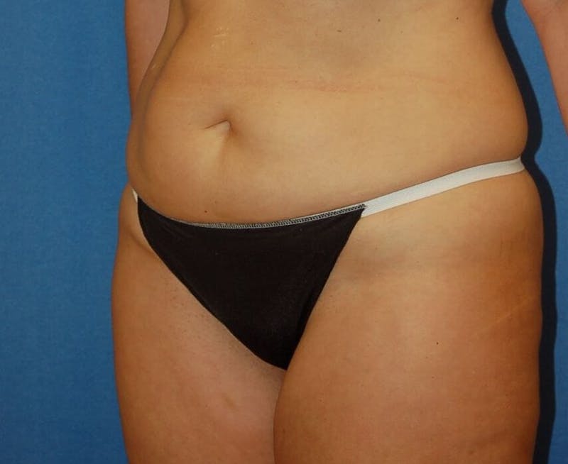 Tummy Tuck Before & After Gallery - Patient 388325 - Image 5