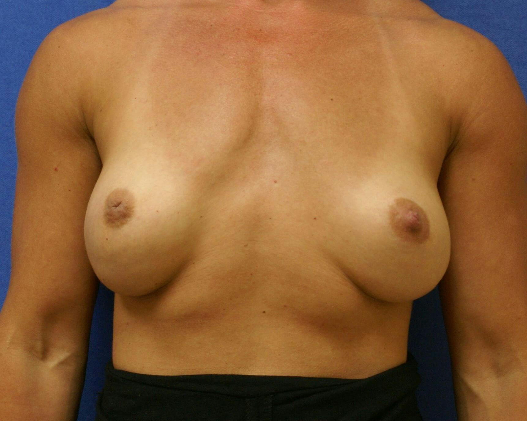 Breast Revision Before & After Gallery - Patient 353372 - Image 1