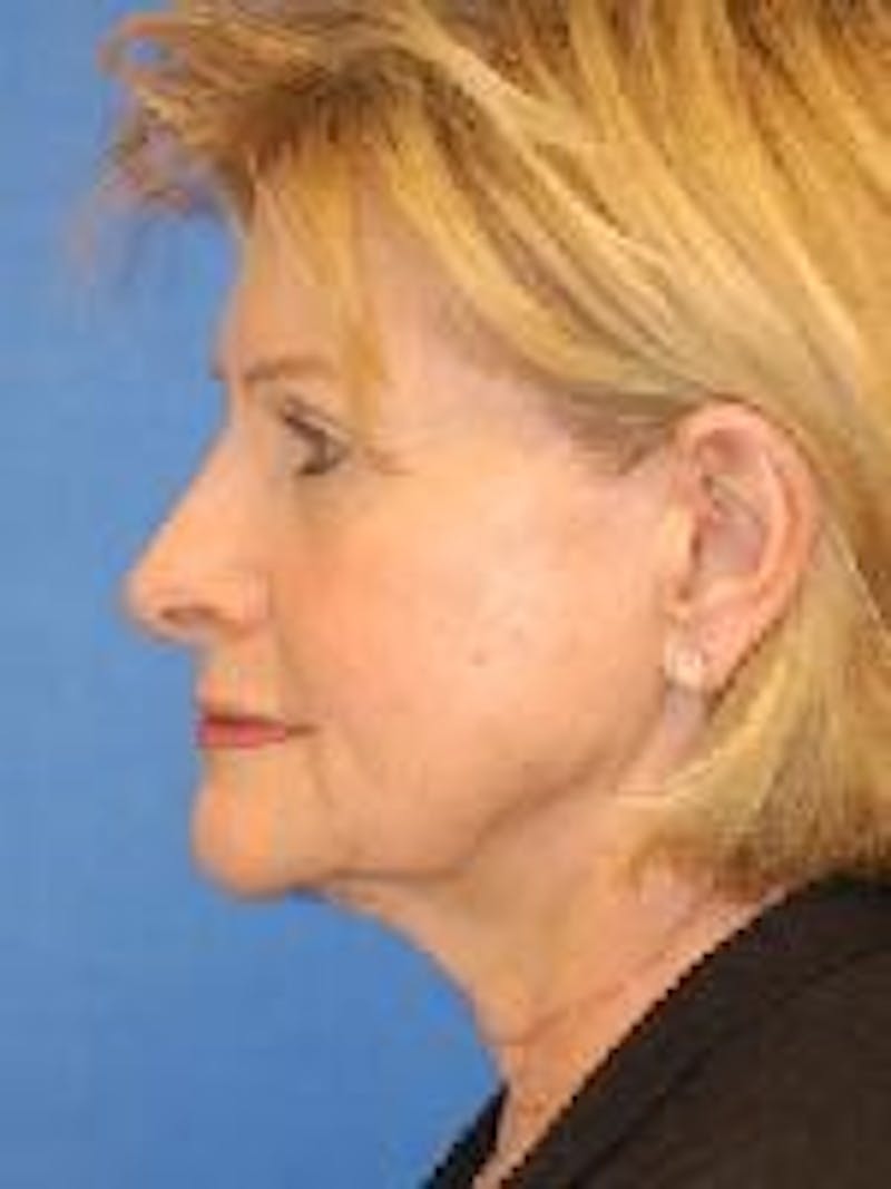 Face Lift Before & After Gallery - Patient 350947 - Image 5