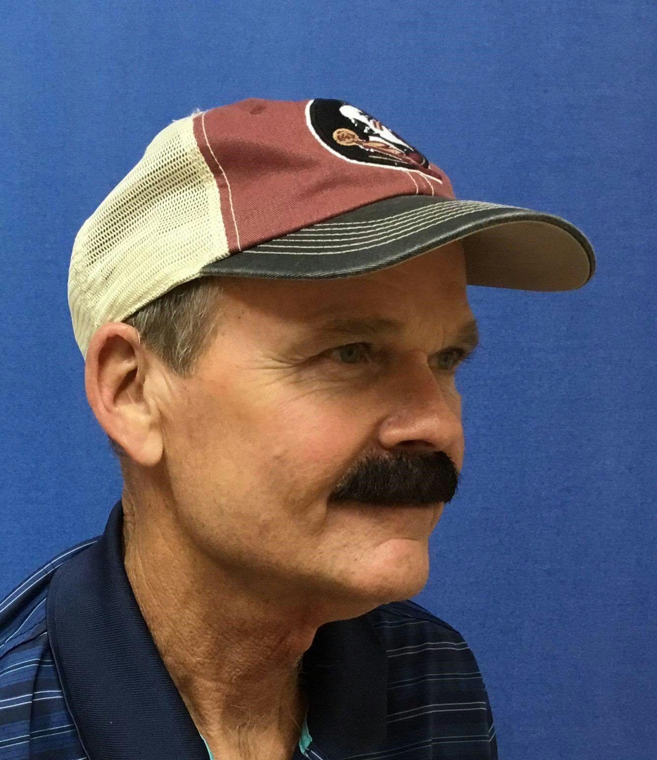 Neck Lift Before & After Gallery - Patient 221587 - Image 1