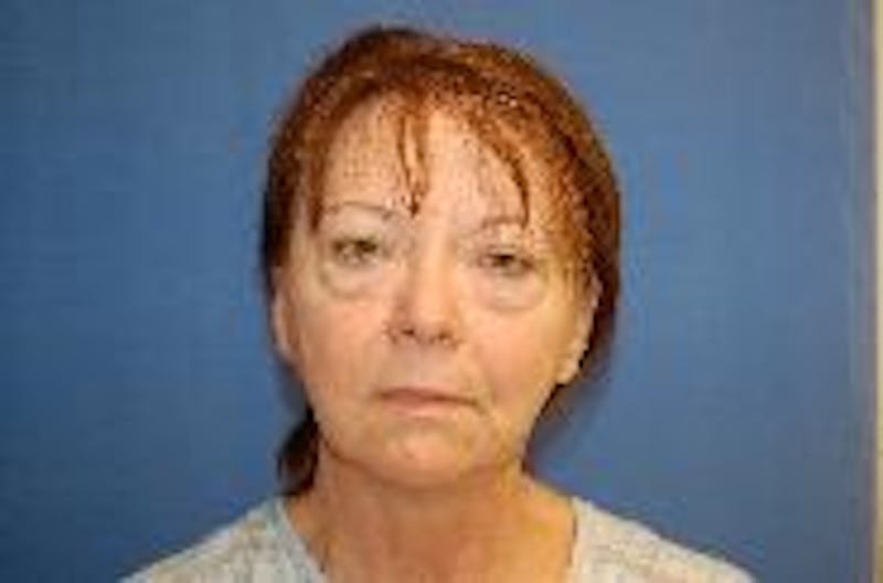 Face Lift Before & After Gallery - Patient 287798 - Image 1