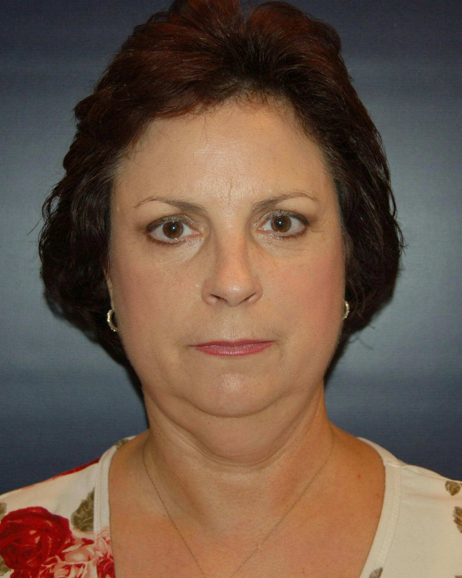 Neck Lift Before & After Gallery - Patient 416397 - Image 1