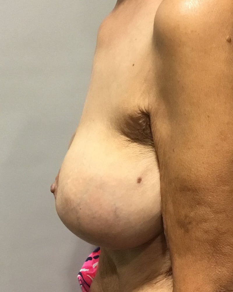 Breast Revision Before & After Gallery - Patient 127822 - Image 3