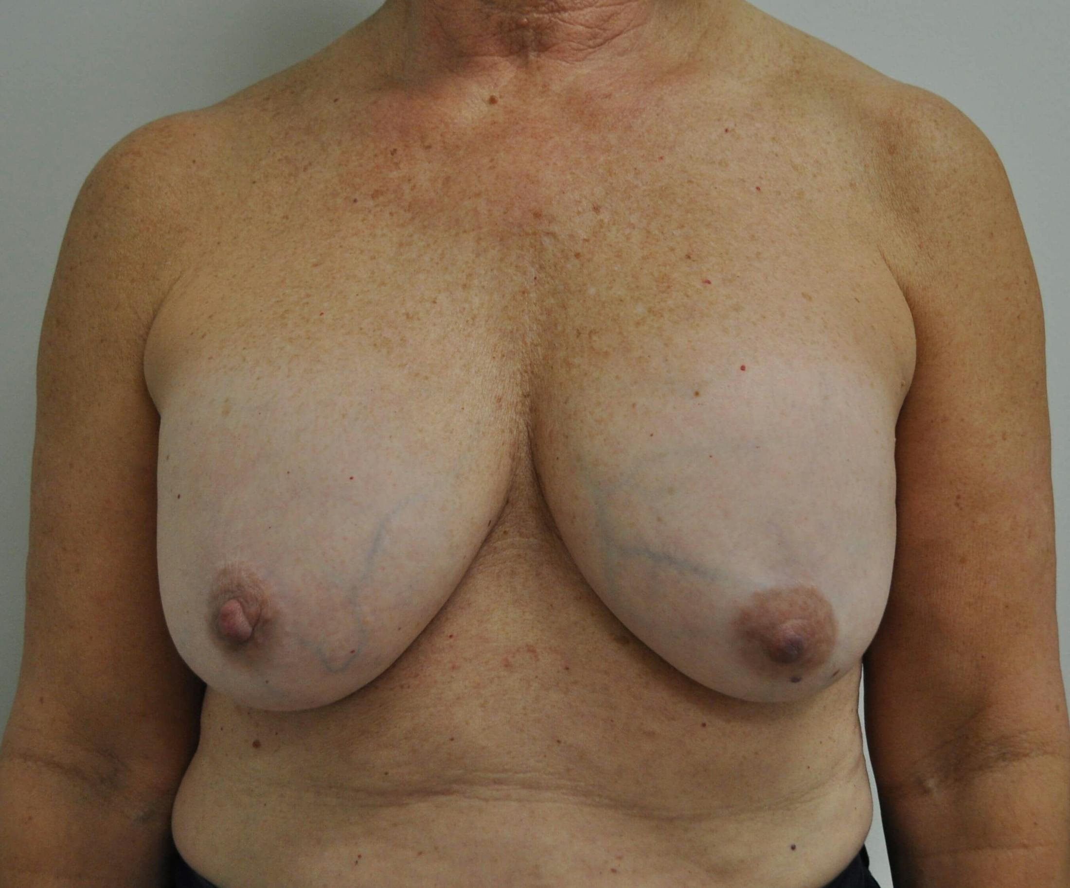 Breast Revision Before & After Gallery - Patient 205410 - Image 1