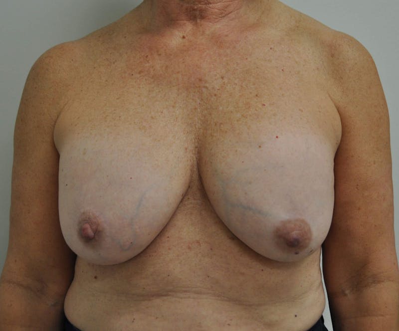 Breast Revision Before & After Gallery - Patient 205410 - Image 1