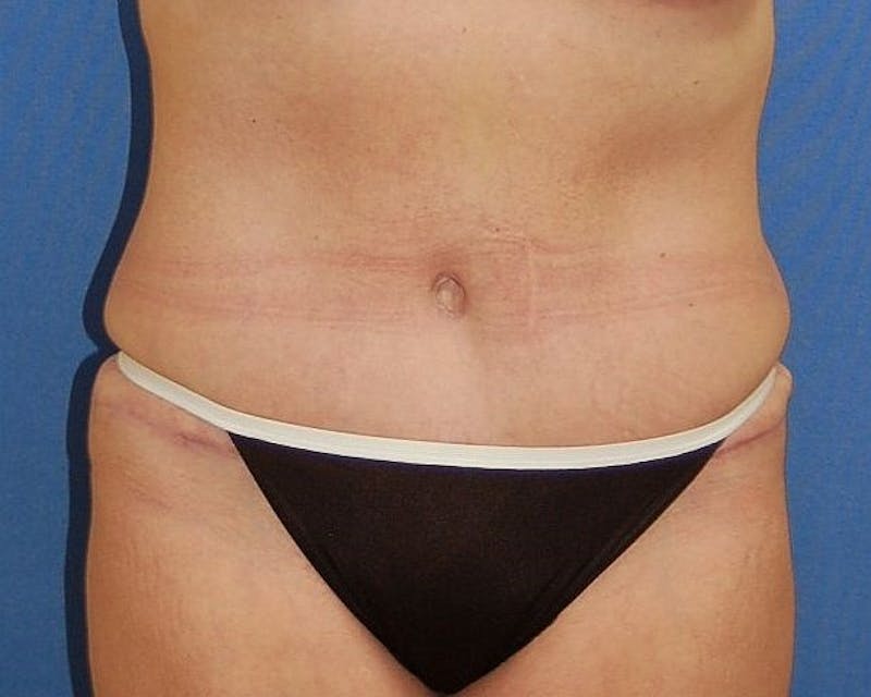 Tummy Tuck Before & After Gallery - Patient 219599 - Image 2