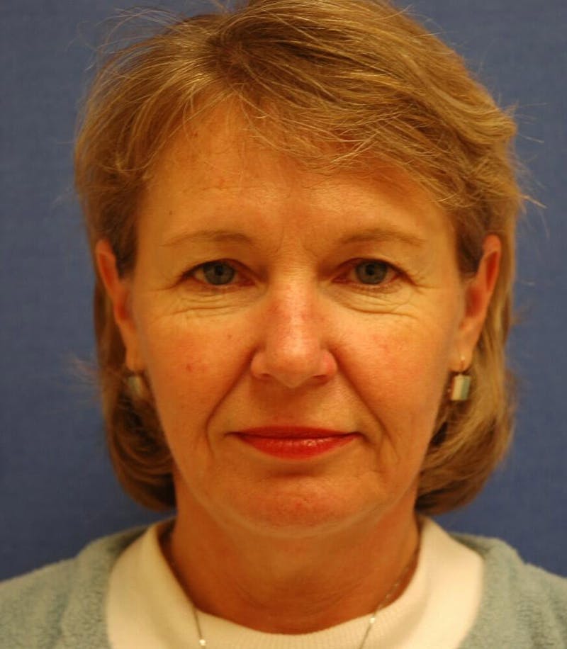 Neck Lift Before & After Gallery - Patient 290473 - Image 1