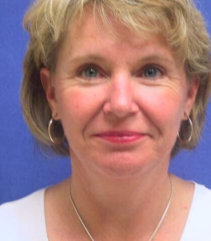 Neck Lift Before & After Gallery - Patient 290473 - Image 2