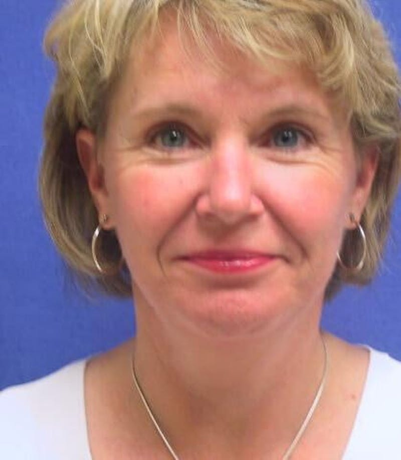Neck Lift Before & After Gallery - Patient 290473 - Image 2