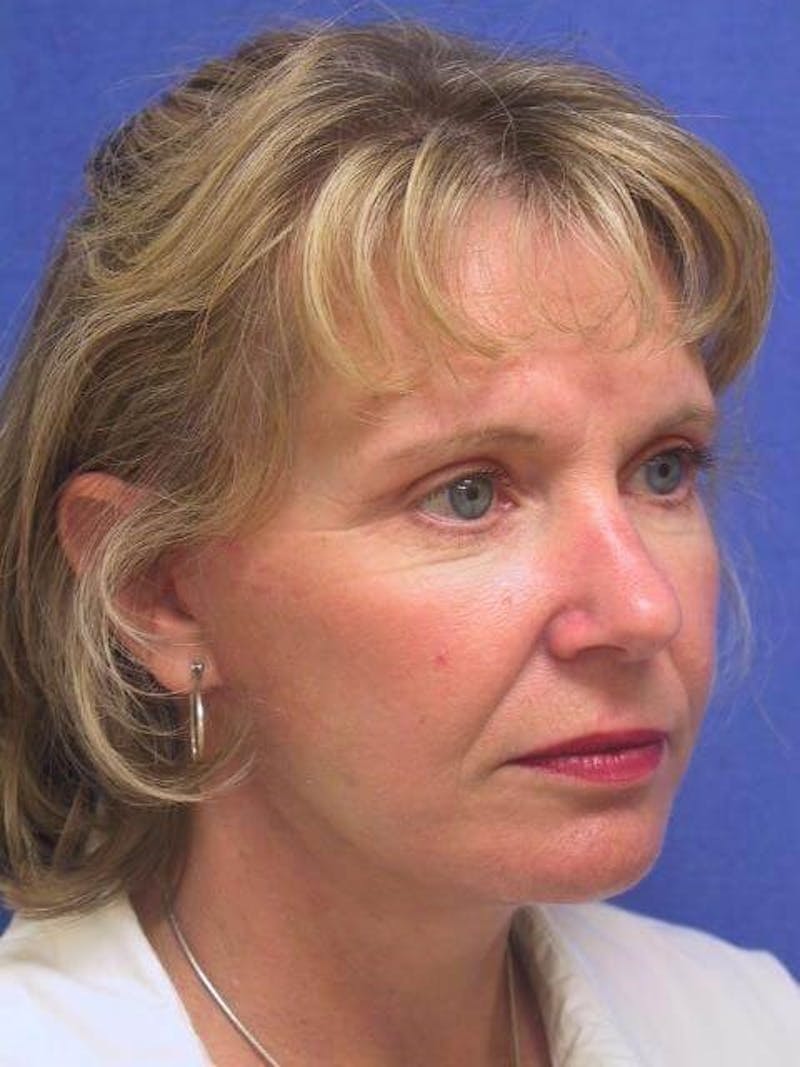 Neck Lift Before & After Gallery - Patient 290473 - Image 4