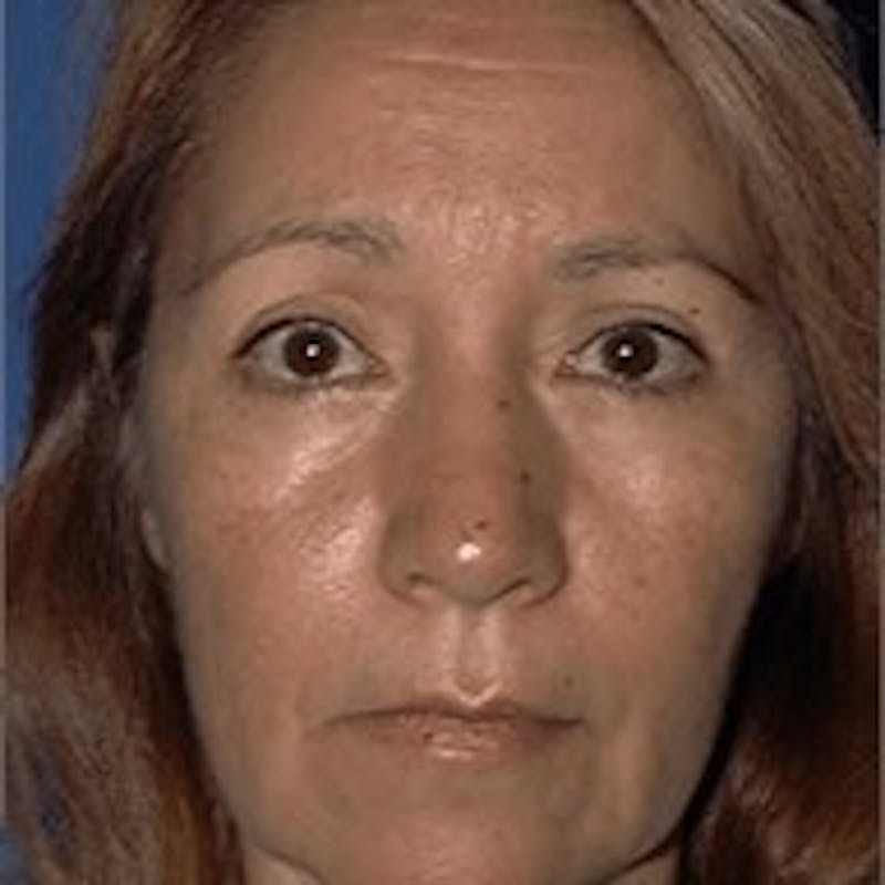 Neck Lift Before & After Gallery - Patient 141786 - Image 1