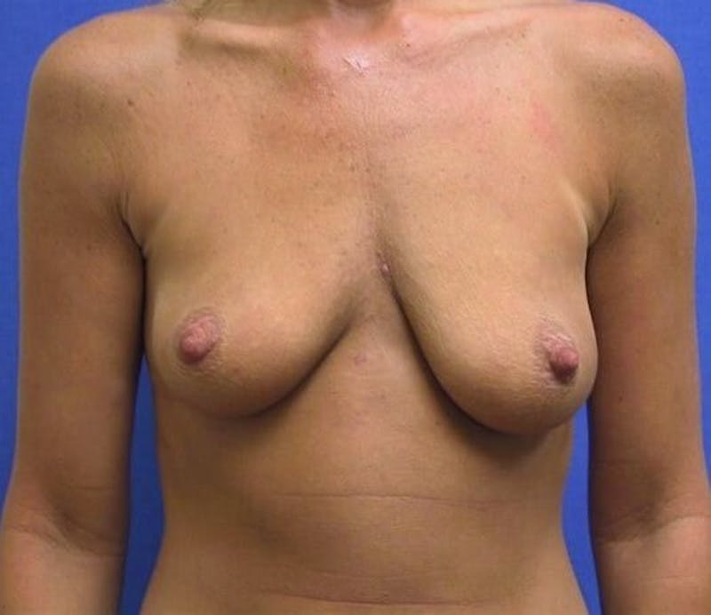 Breast Augmentation With Lift Before & After Gallery - Patient 339953 - Image 1