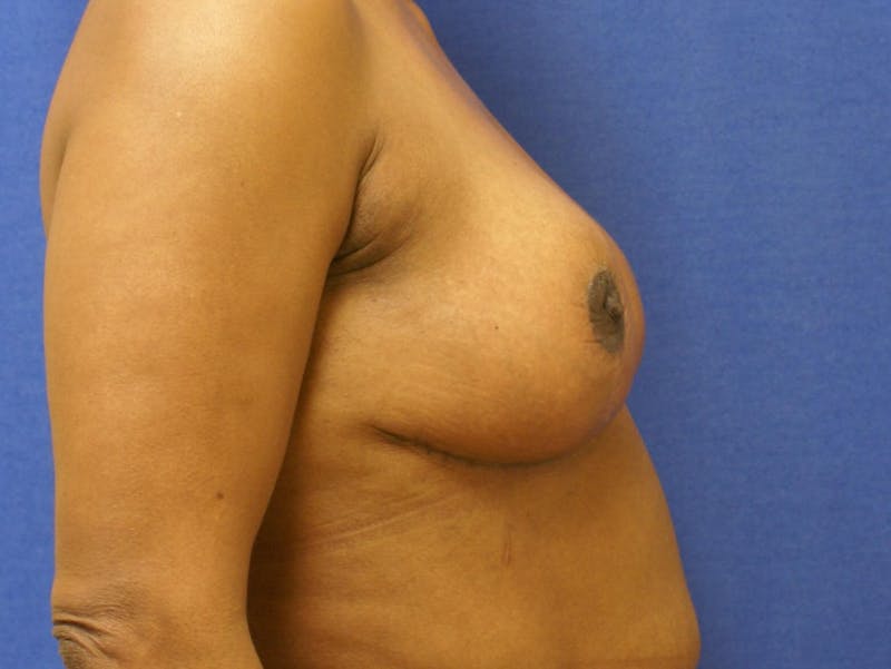 Breast Reduction Before & After Gallery - Patient 184666 - Image 4