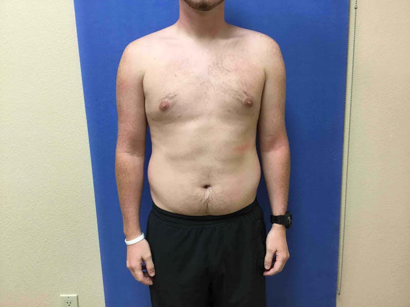 Gynecomastia Before & After Gallery - Patient 761724 - Image 10