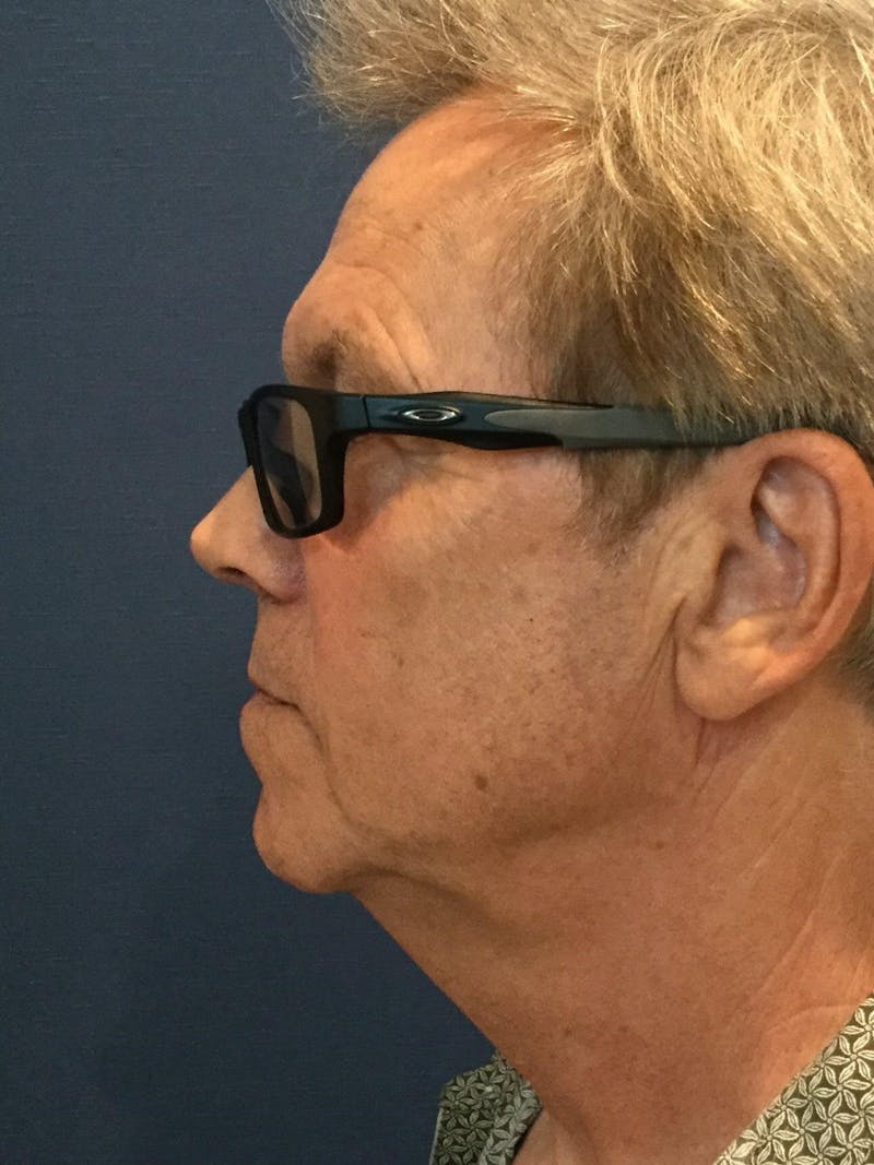 Neck Lift Before & After Gallery - Patient 143382 - Image 3