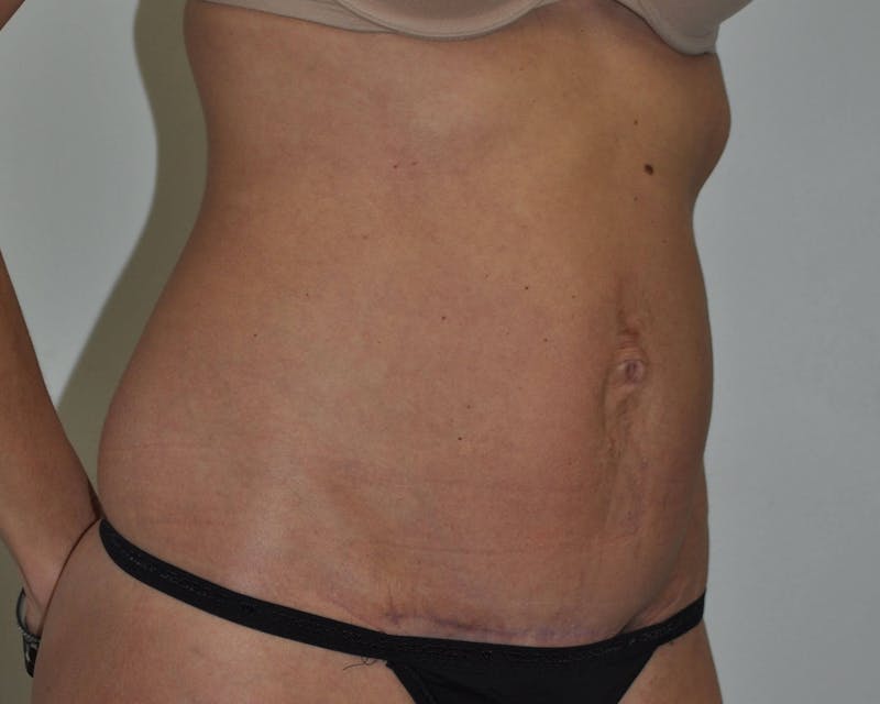 Tummy Tuck Before & After Gallery - Patient 799192 - Image 8