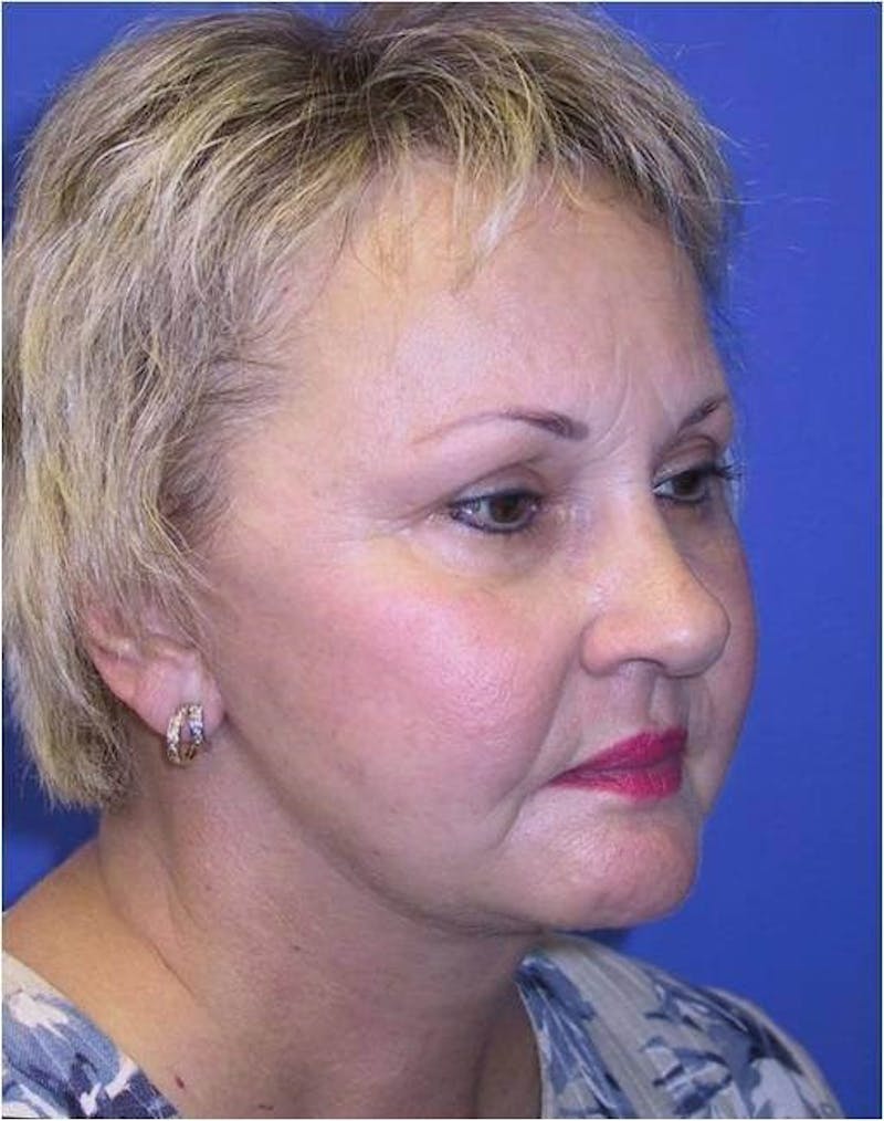 Neck Lift Before & After Gallery - Patient 259614 - Image 2