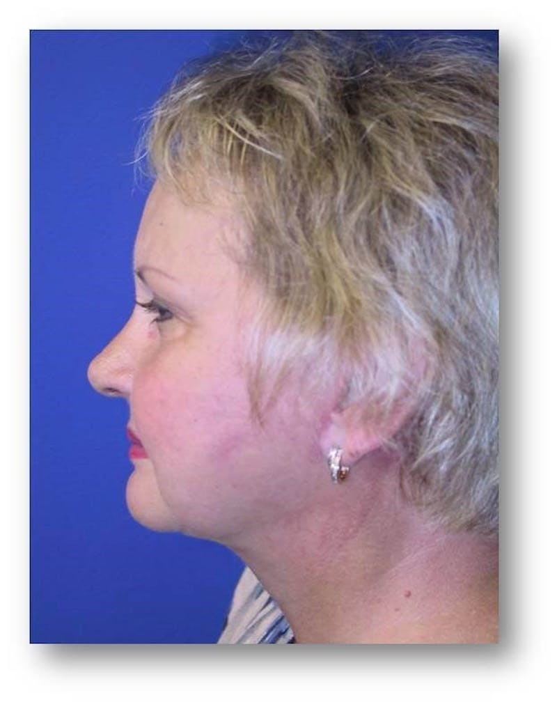 Neck Lift Before & After Gallery - Patient 259614 - Image 4