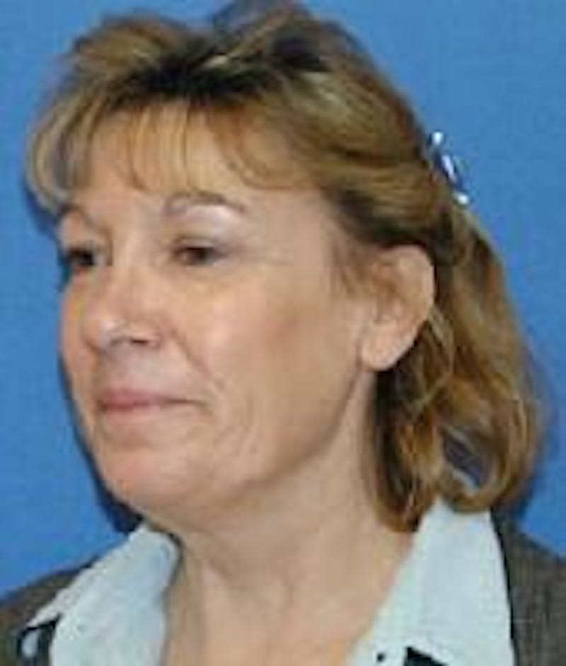 Face Lift Before & After Gallery - Patient 369903 - Image 3