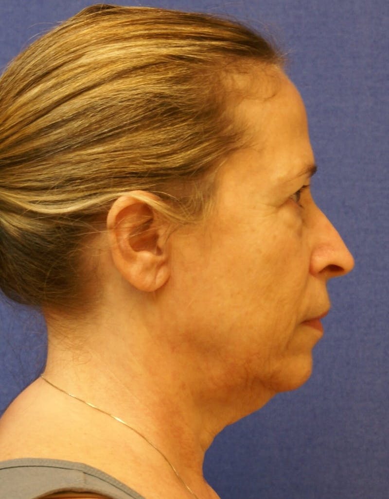 Neck Lift Before & After Gallery - Patient 401602 - Image 3