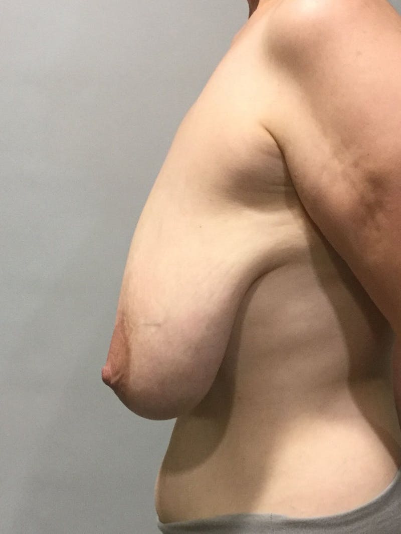 Breast Reduction Before & After Gallery - Patient 207188 - Image 3