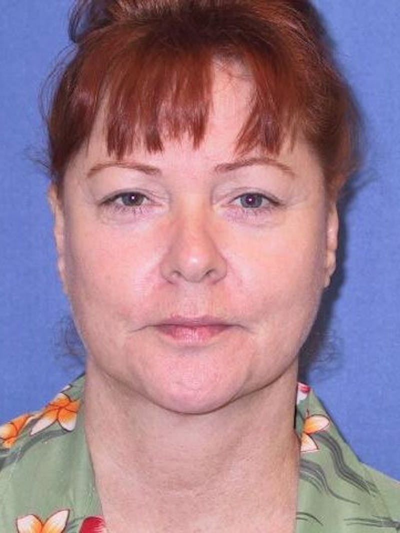 Neck Lift Before & After Gallery - Patient 224285 - Image 2