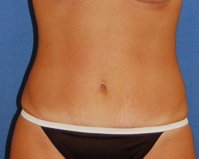 Tummy Tuck Before & After Gallery - Patient 249710 - Image 2