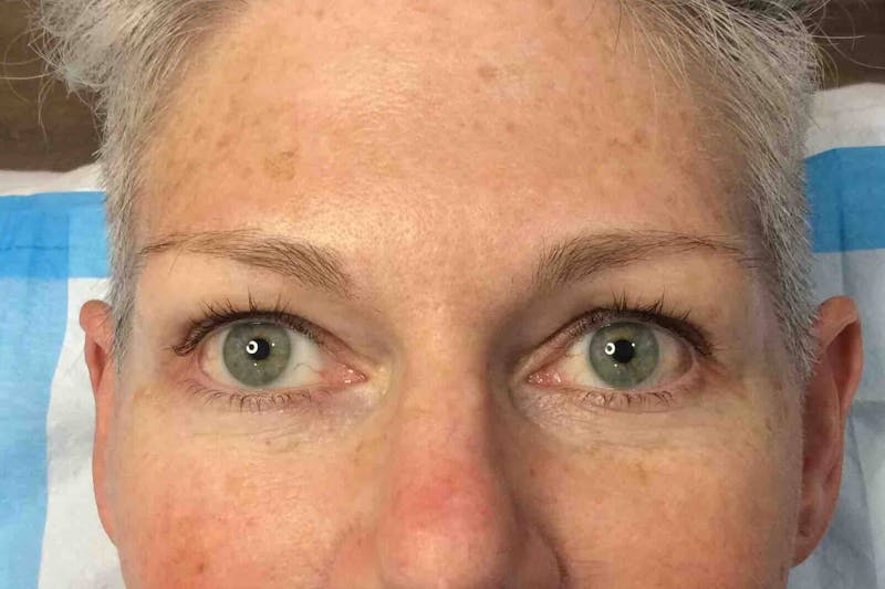 Permanent Makeup Before & After Gallery - Patient 157779 - Image 1