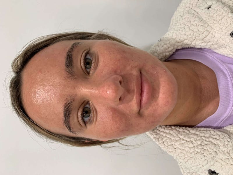 Skin Care Products Before & After Gallery - Patient 426555 - Image 1