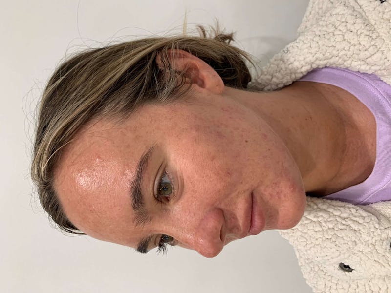 Skin Care Products Before & After Gallery - Patient 426555 - Image 3