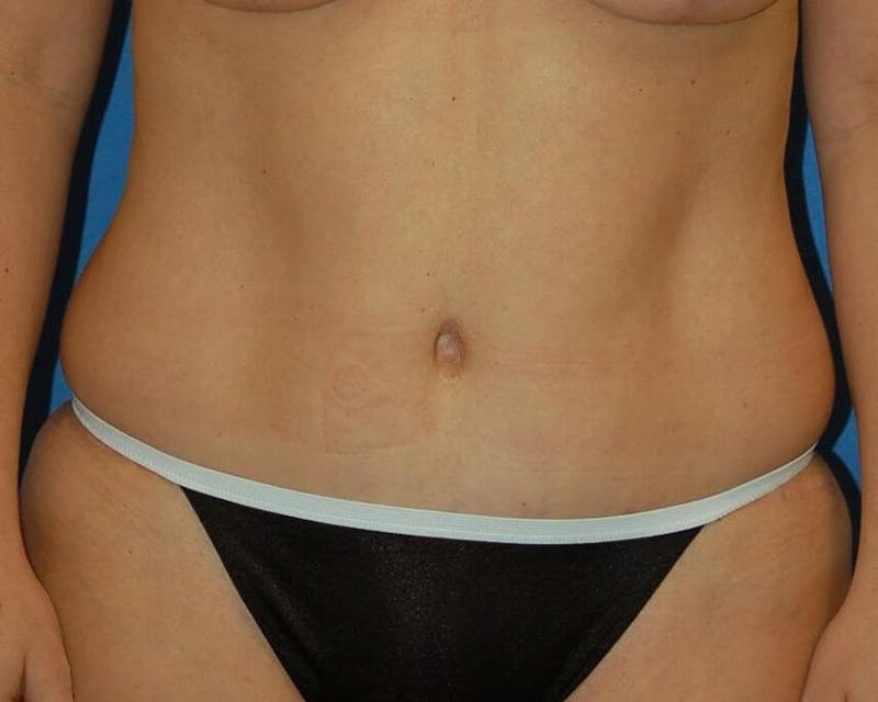 Tummy Tuck Before & After Gallery - Patient 410236 - Image 2