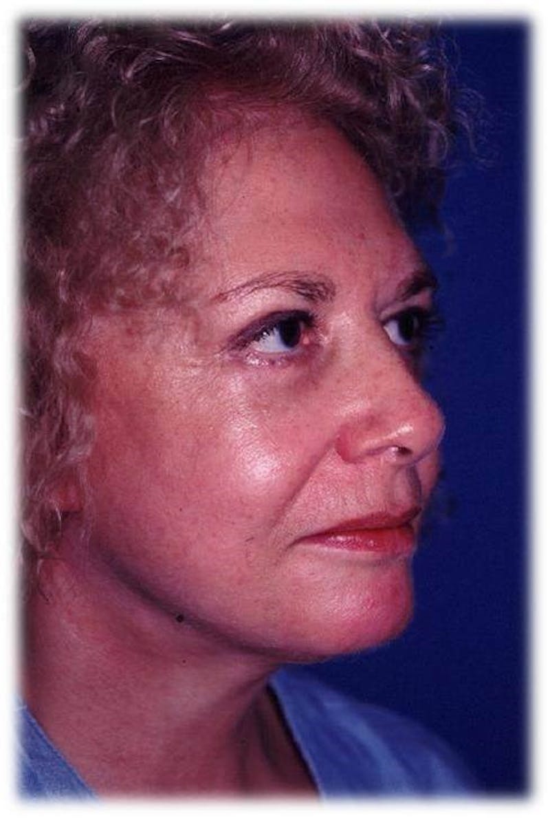 Neck Lift Before & After Gallery - Patient 345694 - Image 2