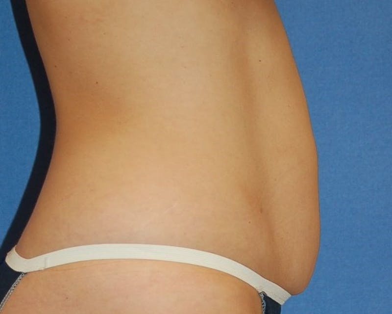 Tummy Tuck Before & After Gallery - Patient 410236 - Image 5