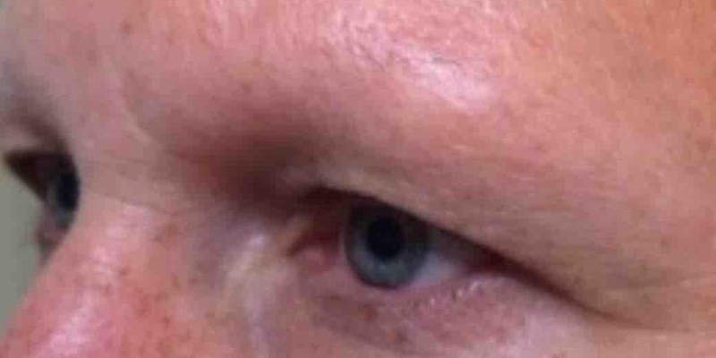 Permanent Makeup Before & After Gallery - Patient 438434 - Image 1