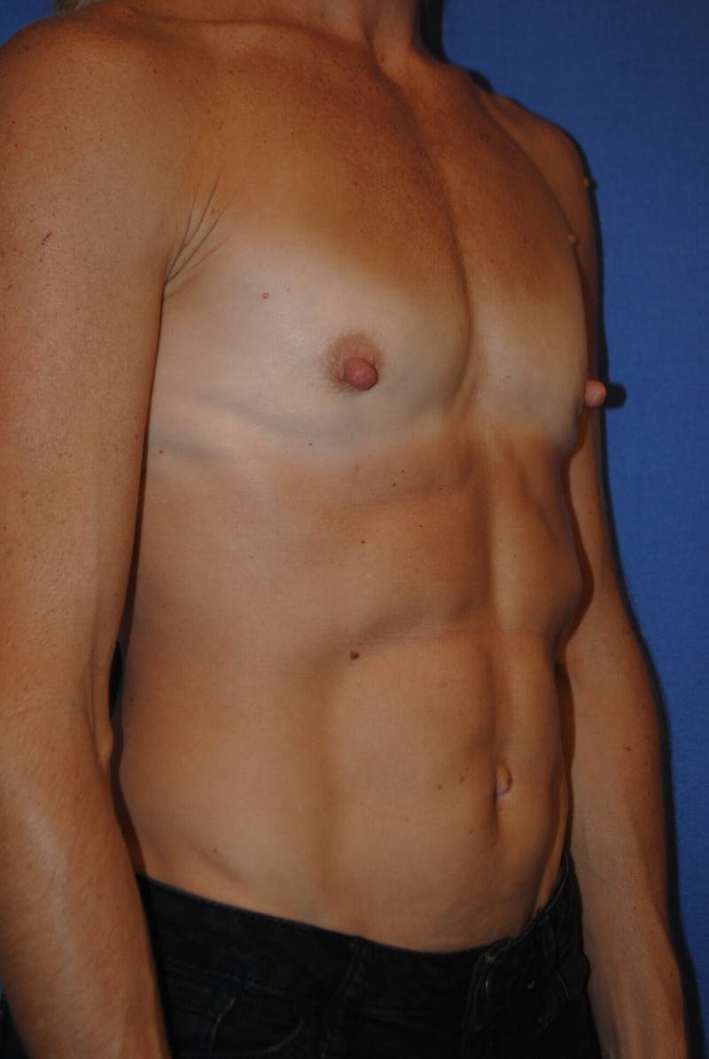 Breast Augmentation Before & After Gallery - Patient 425996 - Image 5