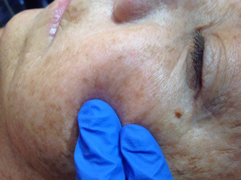 Cryotherapy Before & After Gallery - Patient 950748 - Image 1