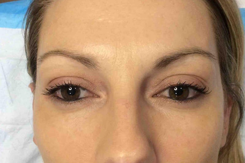 Permanent Makeup Before & After Gallery - Patient 426465 - Image 1