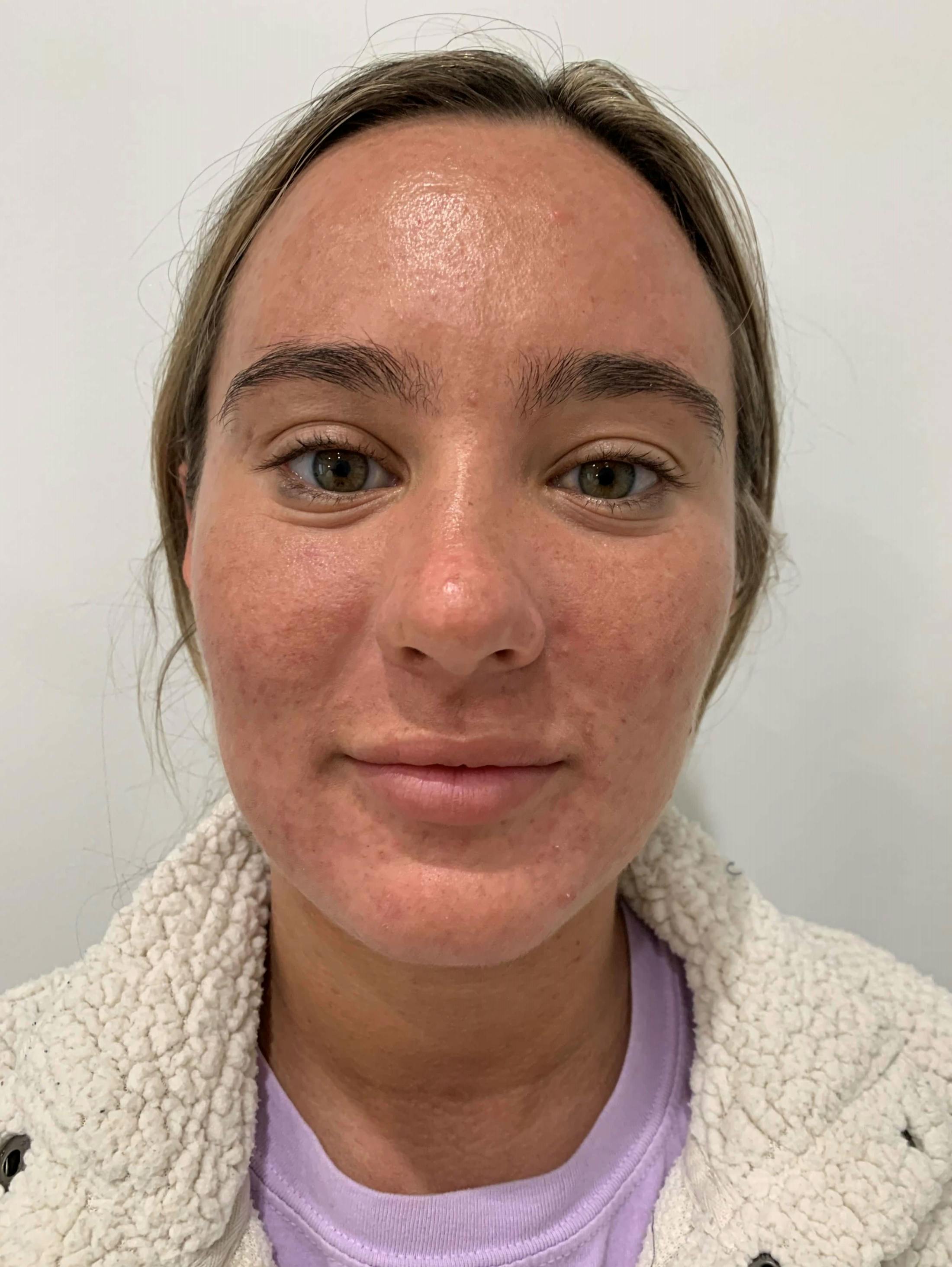 HydraFacial® Before & After Gallery - Patient 423509 - Image 1