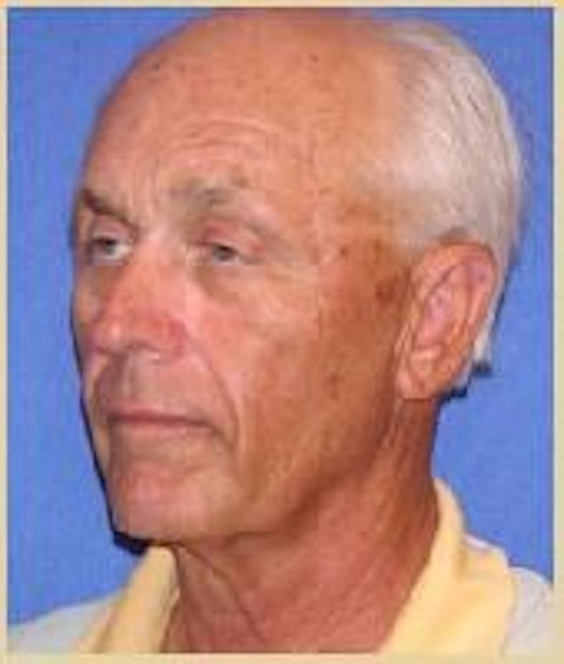 Face Lift Before & After Gallery - Patient 405811 - Image 3