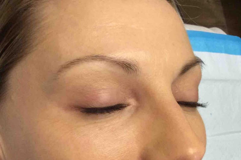 Permanent Makeup Before & After Gallery - Patient 426465 - Image 3