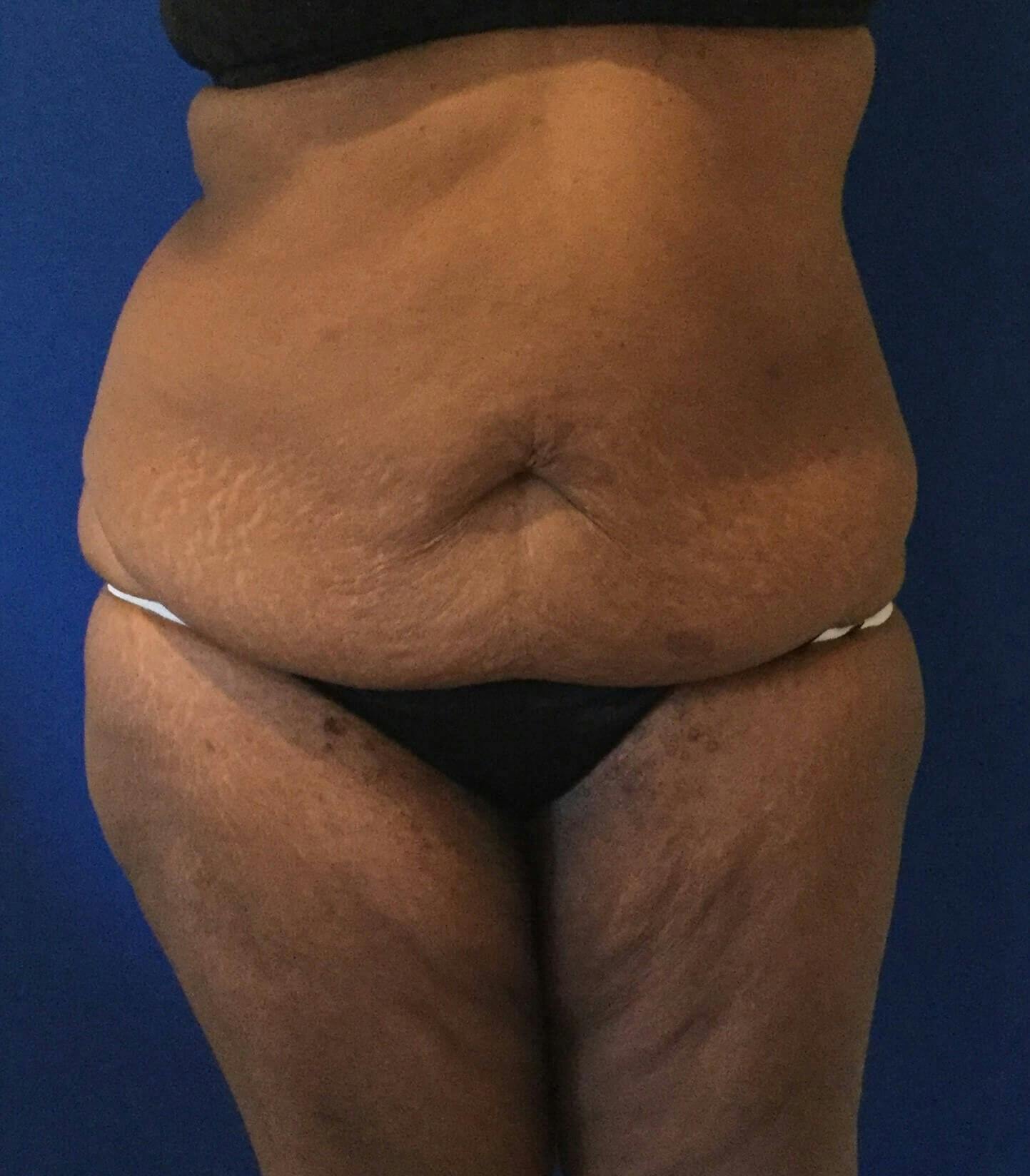Tummy Tuck Before & After Gallery - Patient 147415 - Image 1