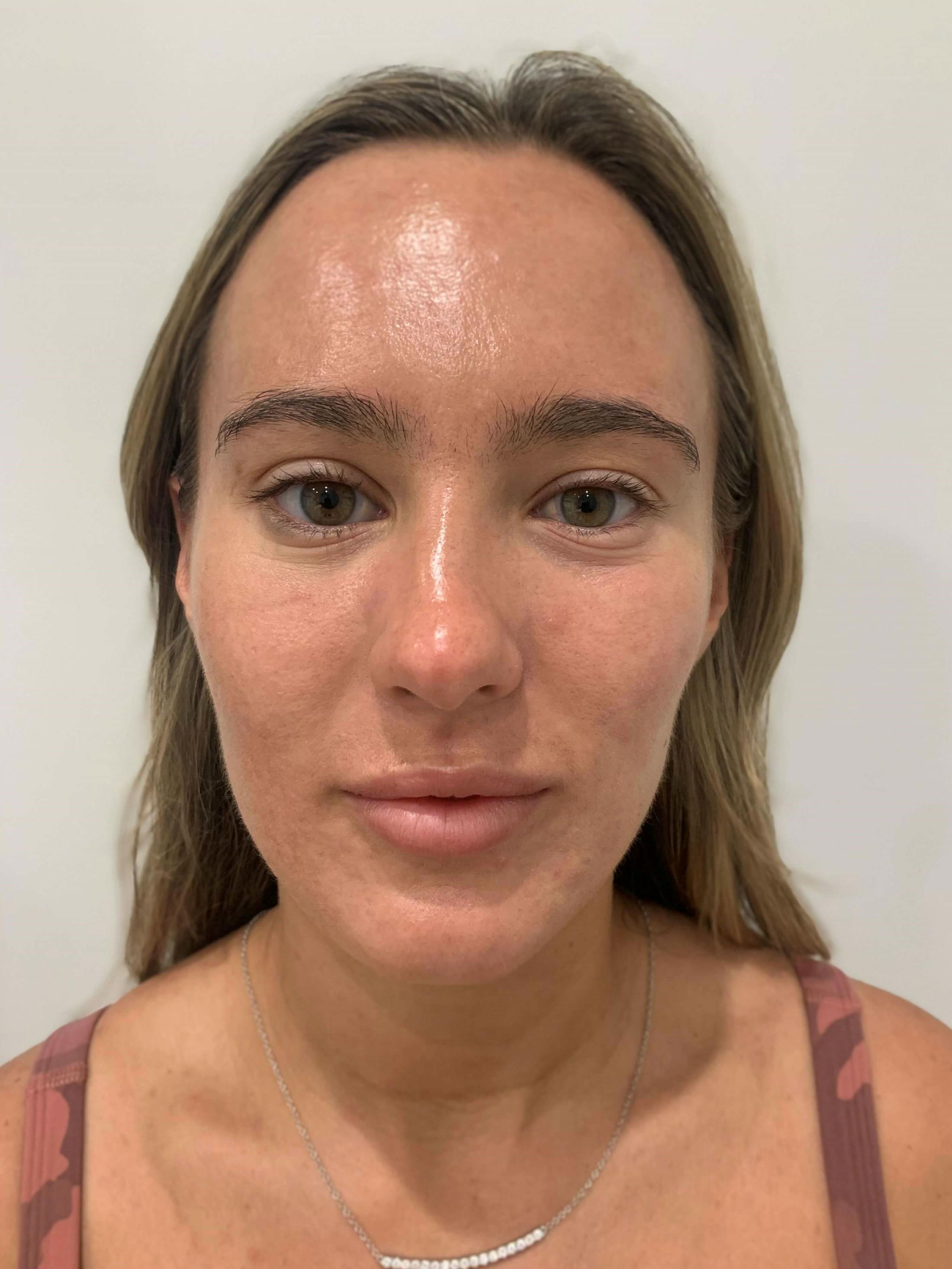 HydraFacial® Before & After Gallery - Patient 423509 - Image 2