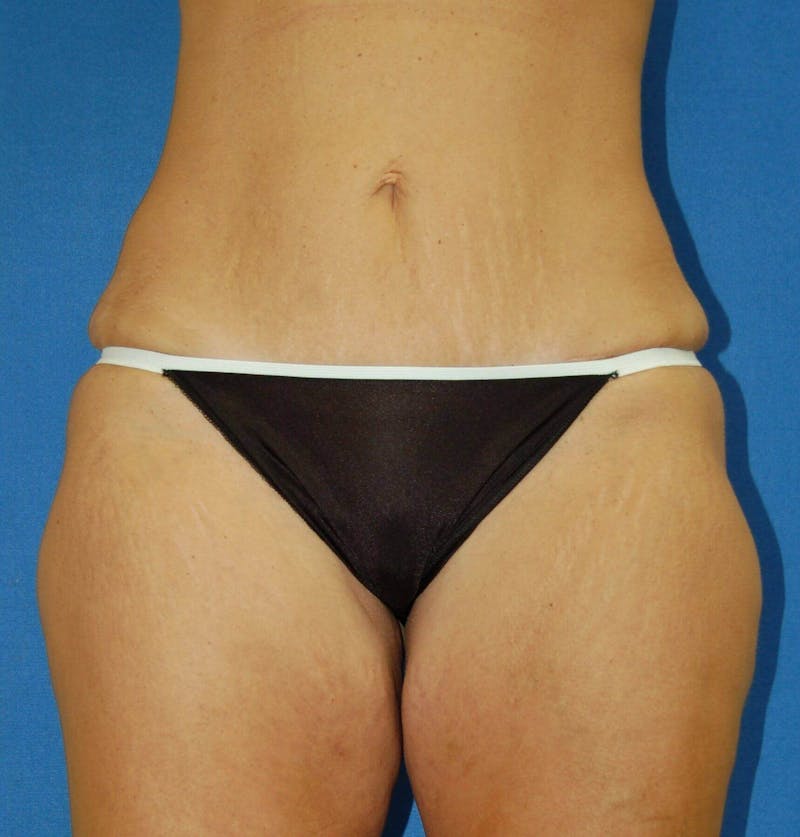 Tummy Tuck Before & After Gallery - Patient 158805 - Image 2