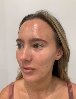 HydraFacial® Before & After Gallery - Patient 423509 - Image 4