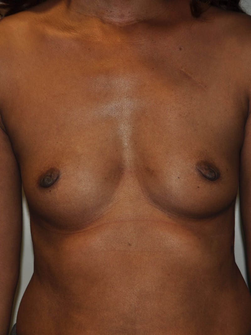 Breast Augmentation Before & After Gallery - Patient 115626 - Image 1